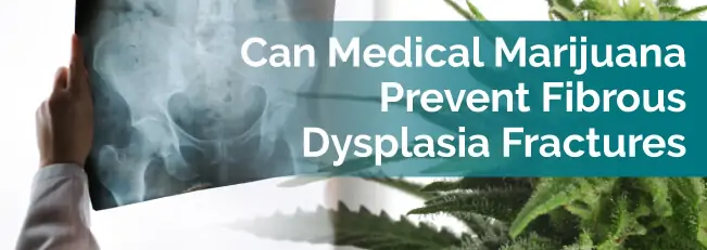 Can Medical Marijuana Prevent Fibrous Dysplasia Fractures?