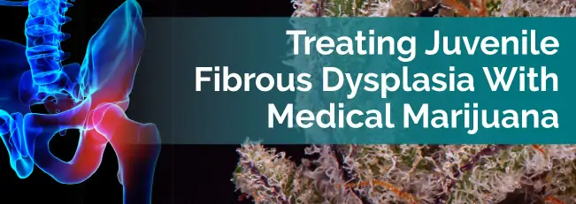 Treating Juvenile Fibrous Dysplasia With Medical Marijuana