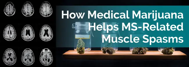 How Medical Marijuana Helps MS-Related Muscle Spasms
