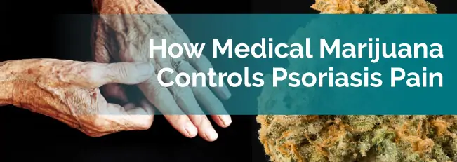 How Medical Marijuana Controls Psoriasis Pain