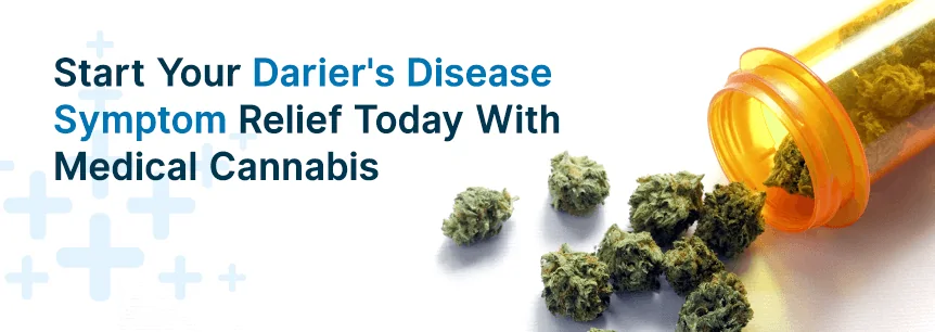 dariers disease relief