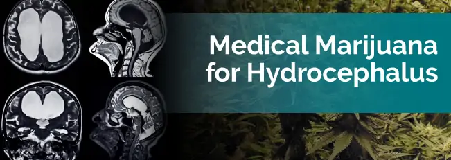 Medical Marijuana for Hydrocephalus
