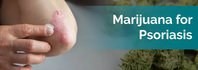 marijuana for psoriasis