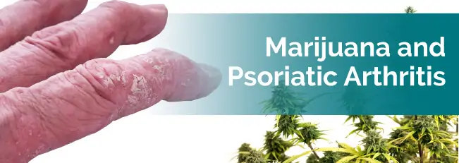 Marijuana and Psoriatic Arthritis