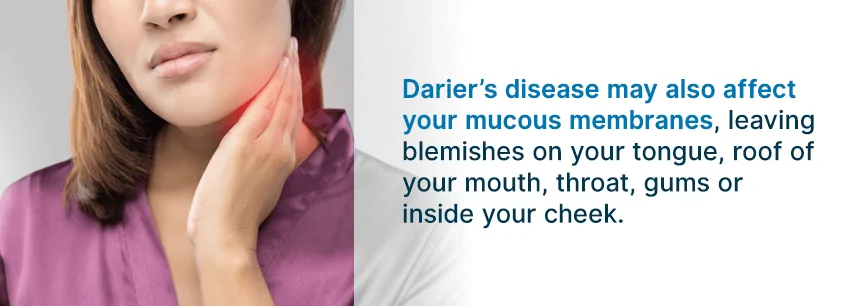 symptoms of dariers disease