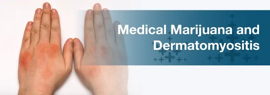 marijuana for dermatomyositis