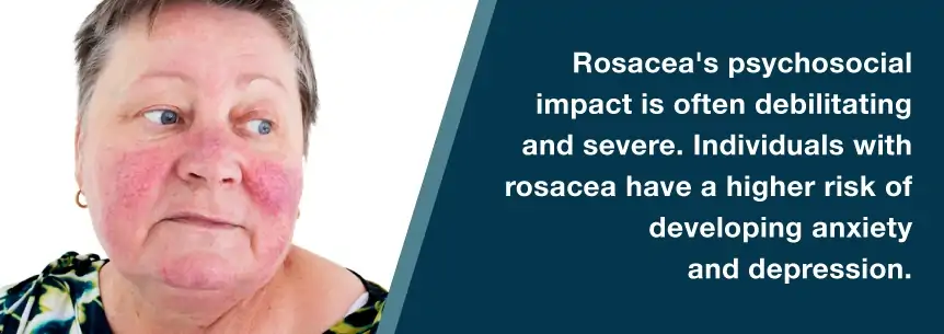 rosacea and depression