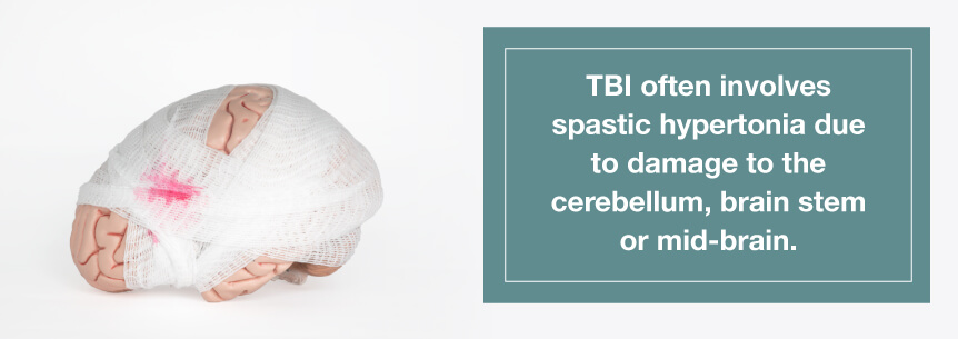 tbi causes