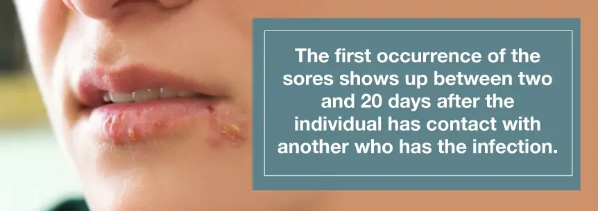how fast herpes