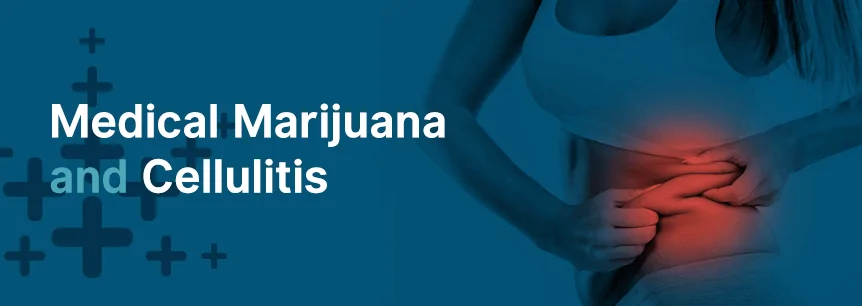marijuana for cellulitis