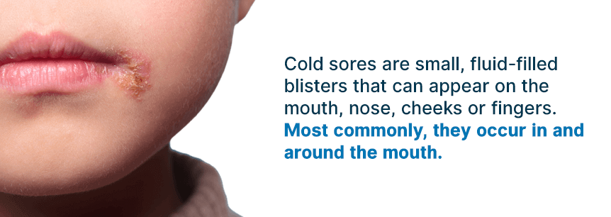 what are cold sores