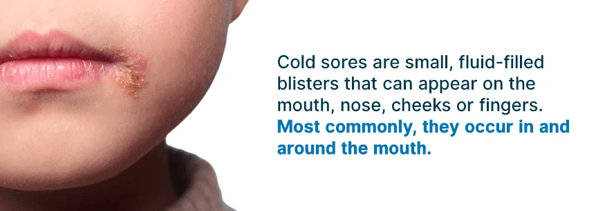 what are cold sores