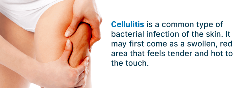 what is cellulitis