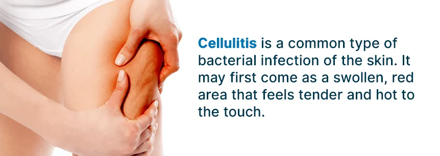 what is cellulitis