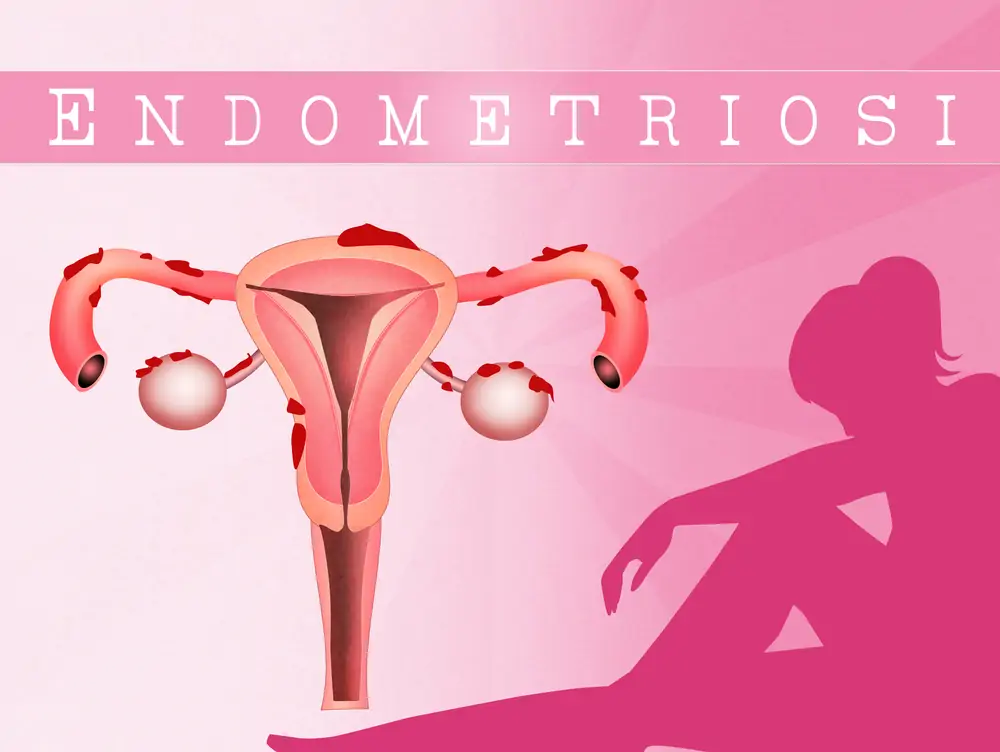 Endometriosis Diagnosis