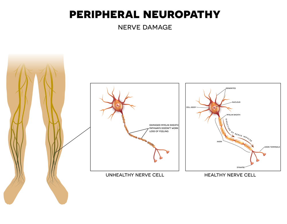 nerve damage diabetes cannabis