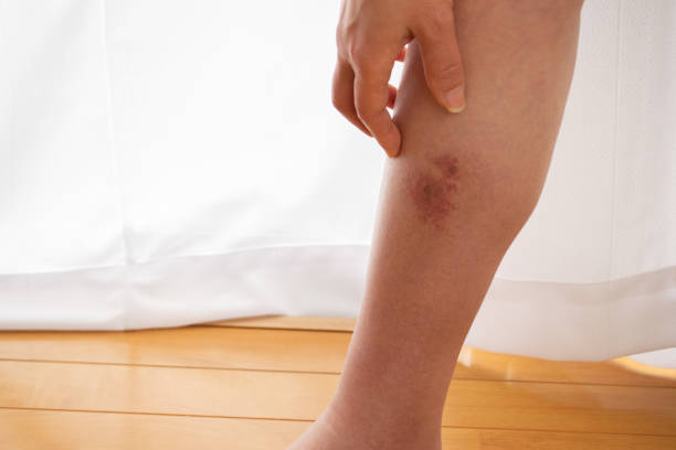 What is Cellulitis?