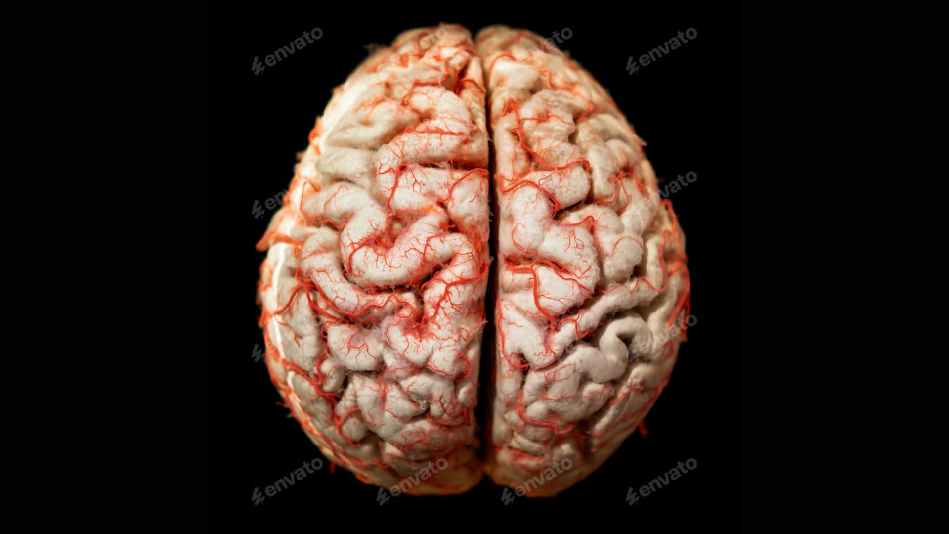 A brain, hydrocephalus