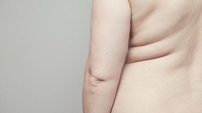 What Is Lipomatosis? A Complete Guide to Causes, Symptoms, and Treatment