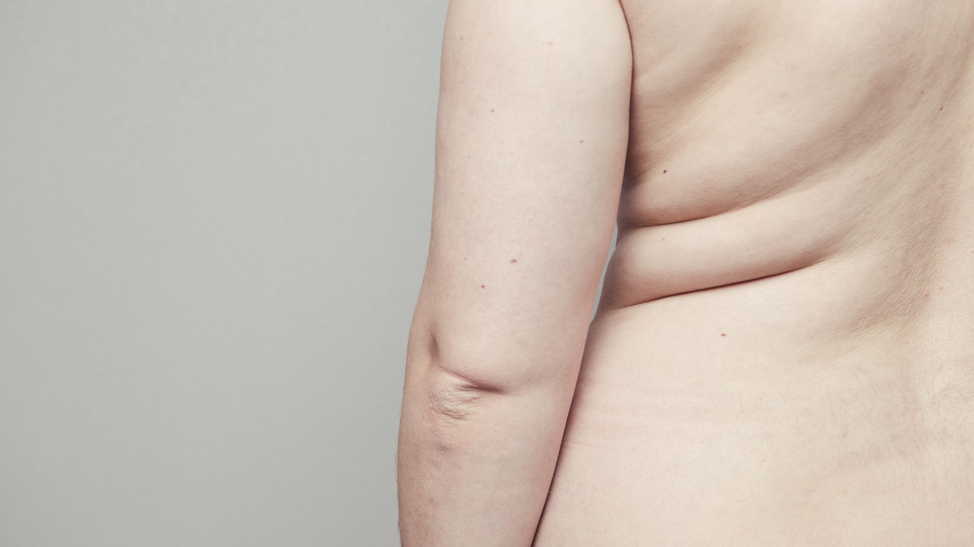 What Is Lipomatosis? A Complete Guide to Causes, Symptoms, and Treatment