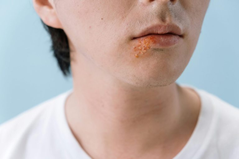 Can Medical Marijuana Help With Cold Sores?