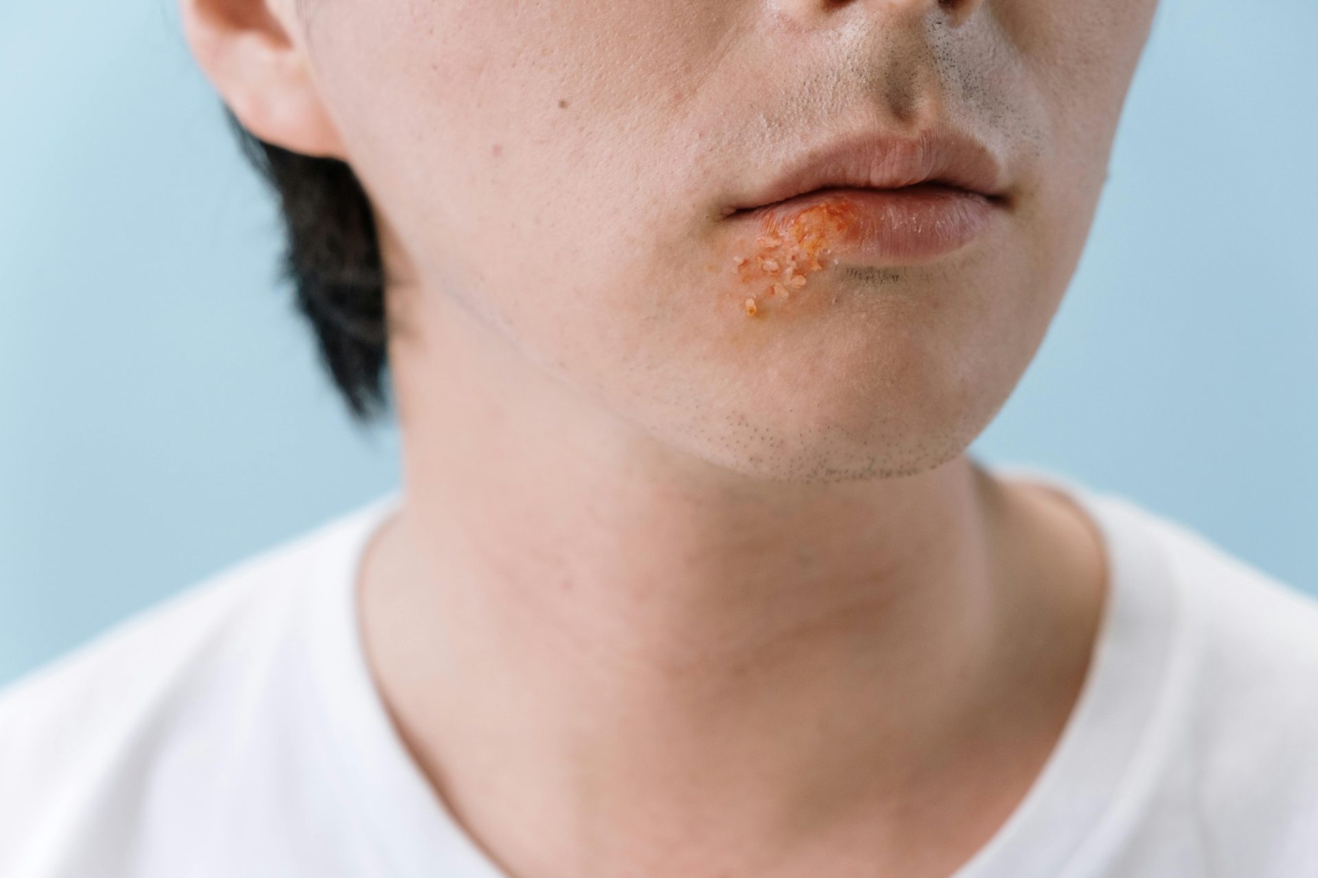 Can Medical Marijuana Help With Cold Sores?