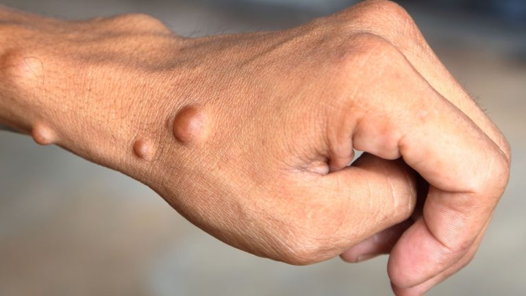 Can Medical Marijuana Help With Neurofibromatosis?