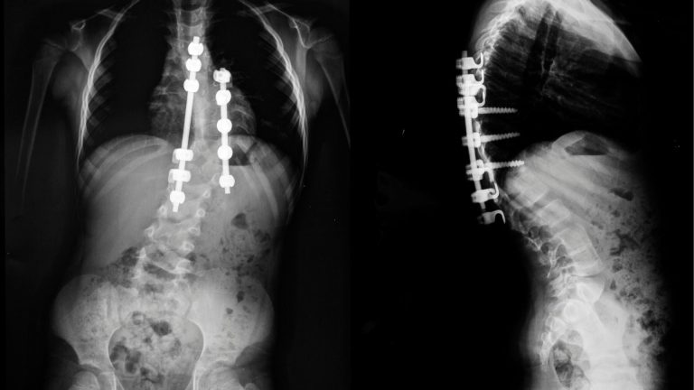 Can Medical Marijuana Help With Scoliosis?