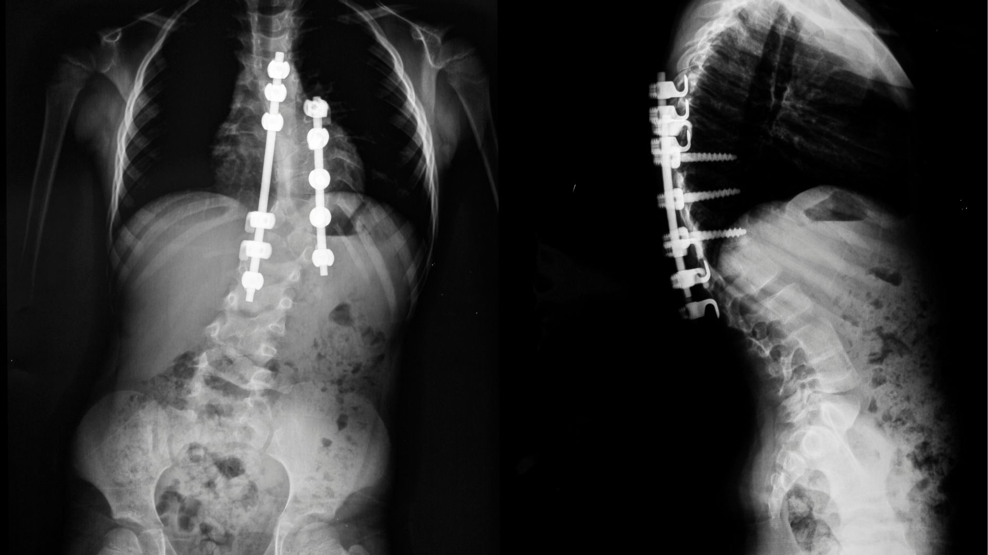 Can Medical Marijuana Help With Scoliosis?